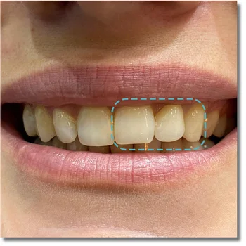 UT ekstremalių 9818mm geriausią estetinį poveikį, cirkonio dantų blokai dantų lab