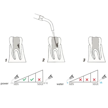 Dantų Priemonių Naudojimo Plėtros Šaknų Kanalų Sienos 1Pcs ED5D Diamond Padengtas Dantų Endodontinis Patarimas SATELEC Ir DTE Scaler